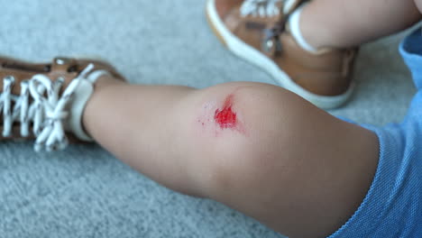 Close-up-Abrasion-Wound-on-Toddler's-Knee