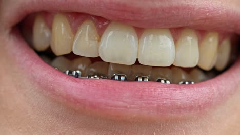 Macro-shot-of-mouth-smiling-with-braces-on-bottom-teeth-in-slow-motion
