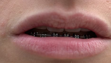 Extreme-close-up-of-a-smilling-womans-mouth-which-waer-braces