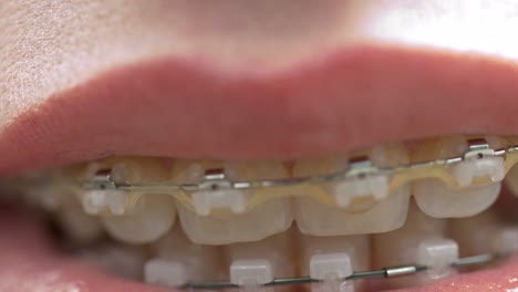 Extreme-close-up-shot-of-a-mouth-with-braces