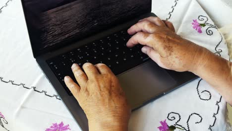 Woman-with-vitiligo-on-her-hands-working-on-the-computer