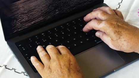 Vitiligo-An-Den-Händen-Einer-Frau,-Die-Am-Computer-Arbeitet