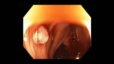 Precancerous-Polyp-In-The-Colon-Found-And-Removed-During-Colonoscopy-Procedure-For-Analysis