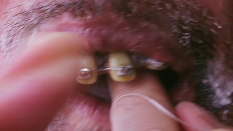 Eine-Groteske-Nahaufnahme-Eines-Hässlichen,-Gruseligen,-Offenen-Mundes,-Der-Zahnseide-Mit-Zahnspangen-Verwendet