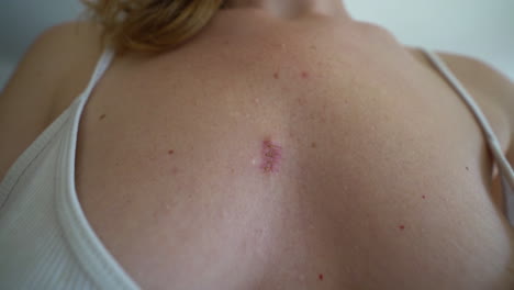 A-wound-that-heals-and-turns-into-a-scar-after-removing-a-cyst-on-a-woman's-breast