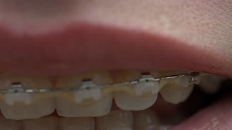 Klammersystem-Im-Lächelnden-Mund,-Makrofoto-Auf-Weißen-Zähnen-Mit-Kieferorthopädischen-Klammern