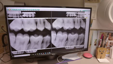 Röntgen-Auf-Dem-Computer-Ein-Bildschirm-Der-Zähne-Des-Patienten-In-Der-Zahnarztpraxis