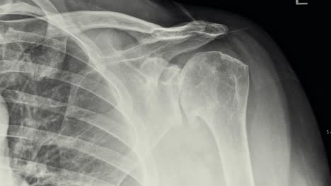 X-Ray-showing-shoulder-arthritis,-requiring-shoulder-replacement-surgery