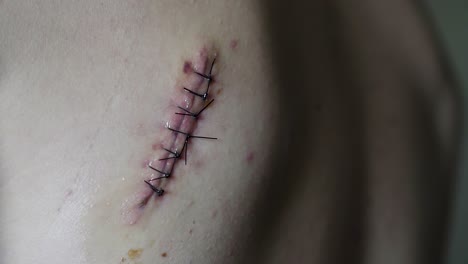 Macro-extreme-close-up-of-large-intense-stitches-on-the-back-of-a-white-male-after-a-surgery